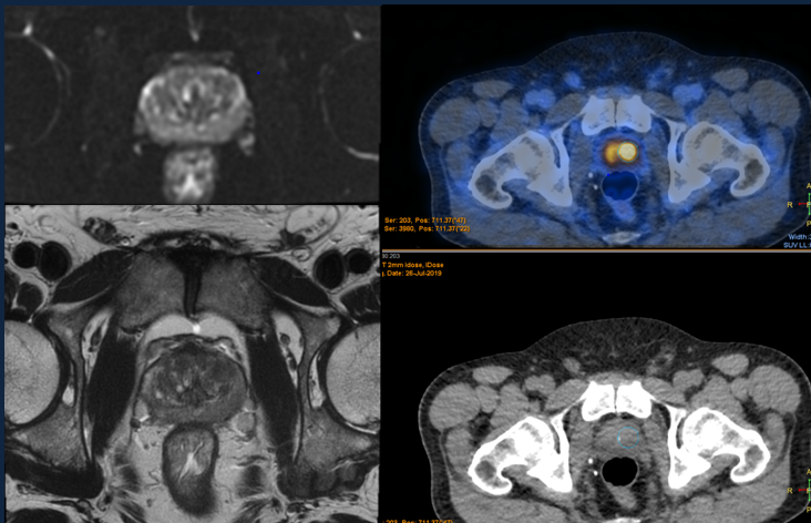 MRI - PSMA PET scan